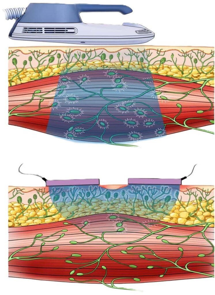 differenze tra EMS e Stimolazione Magnetica