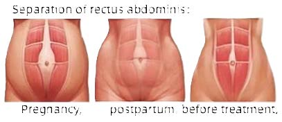 Diastasti Addominale